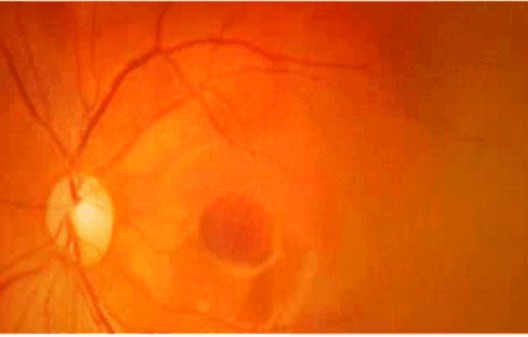 retinopatia diabetica cirugia
